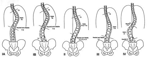 escoliosis pilates