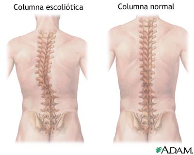 columna normal y columna escoliótica