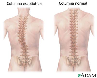 escoliosis pilates