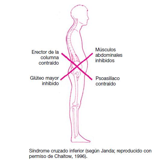 sindrome cruzado inferior