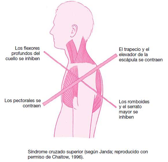 sindrome cruzado superior