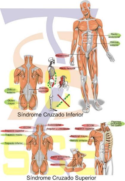 Sindromes cruzados posturales